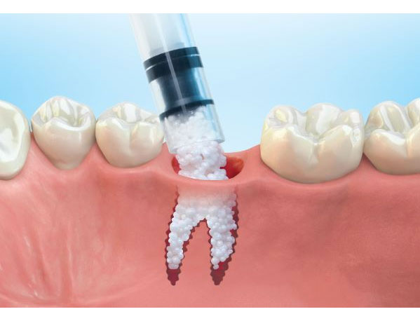 Bone Grafting Procedures